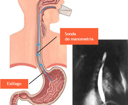 Manometria Esof Gica Manometria Anorretal Endov Deo Preven O Diagn Stico E Tratamento Em